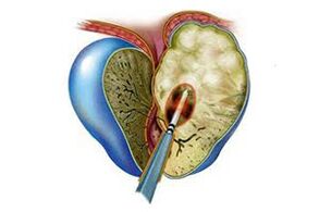 проявления острого простатита